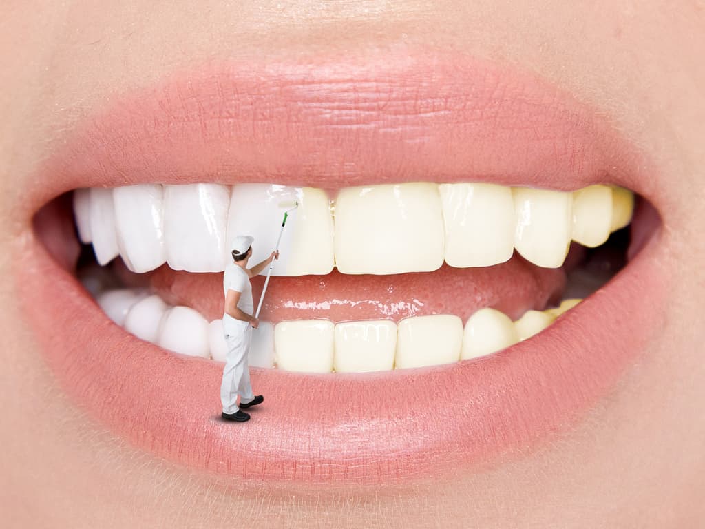 blanchiment dentaire realise par un peintre en batiments miniature