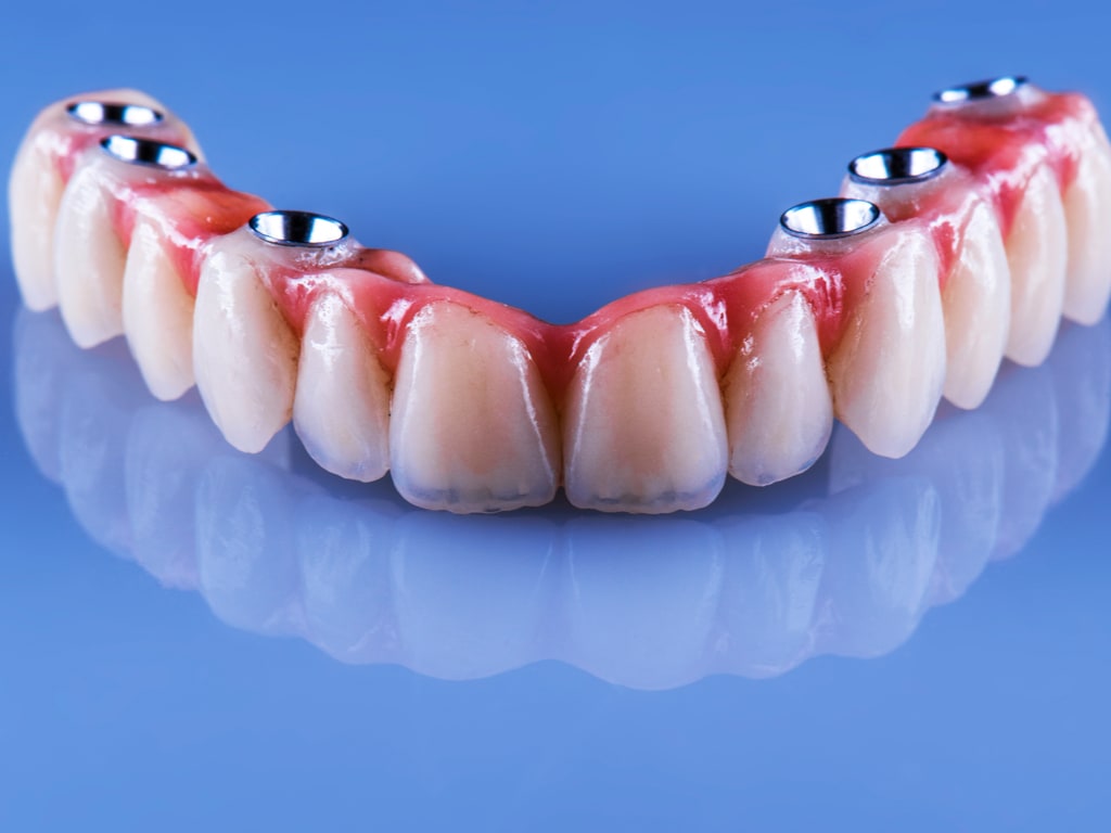 bridge dentaire complet sur implants